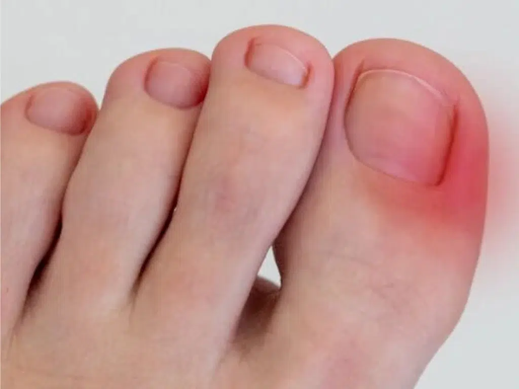 Uñas encarnadas